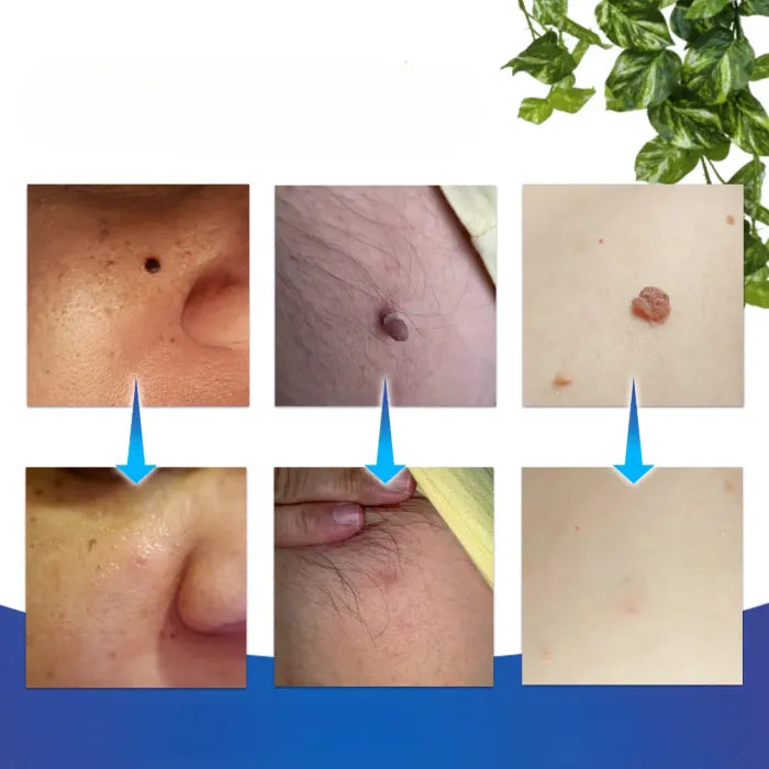 2-in-1 Painless Skin Tag, Mole, and Wart Removal Kit