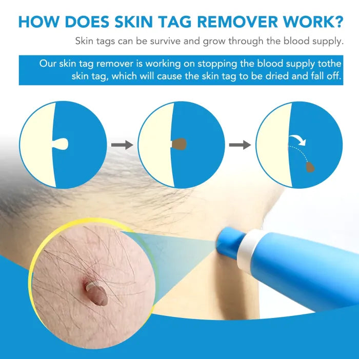 2-in-1 Painless Skin Tag, Mole, and Wart Removal Kit